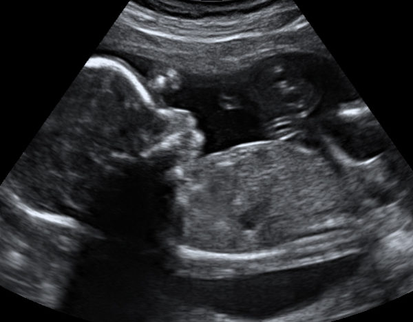 Photo Gallery | 3D Keepsake Imaging | Prenatal Ultrasound & Scanning