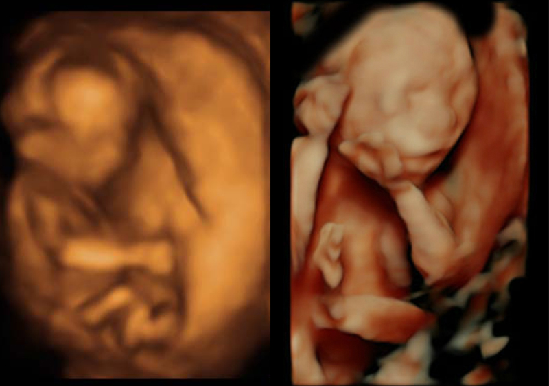 3d sonogram 3d sonogram